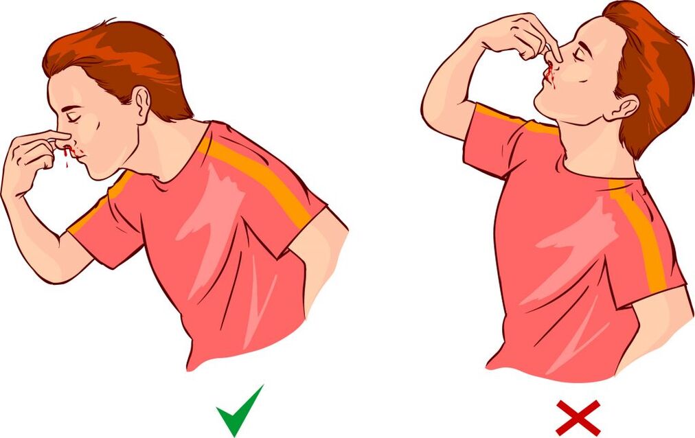 Epistaxis pentru hipertensiune arterială