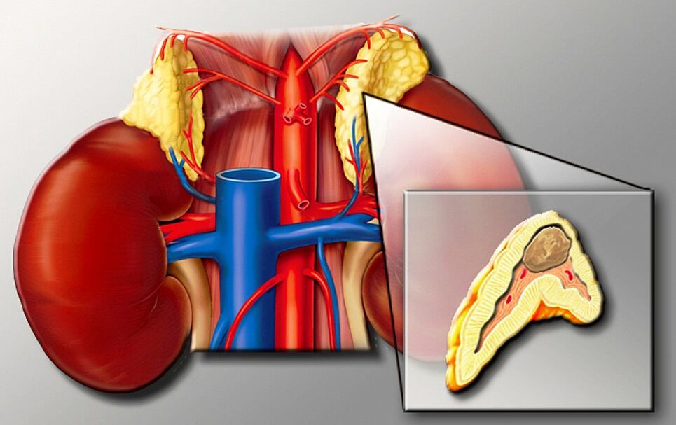 Feochromocitom pentru hipertensiune arterială